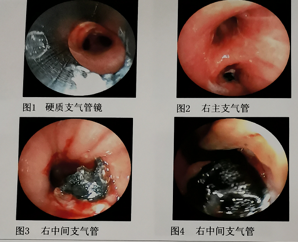 明确诊断及治疗都需要支气管镜检查,怎么办?