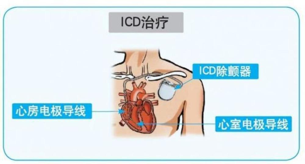 丹麦国家队:埃里克森已同意植入心脏复律除颤器