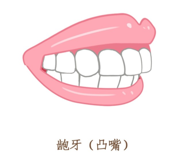 这几种牙齿类型的人越早矫正越好