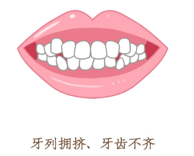这几种牙齿类型的人越早矫正越好