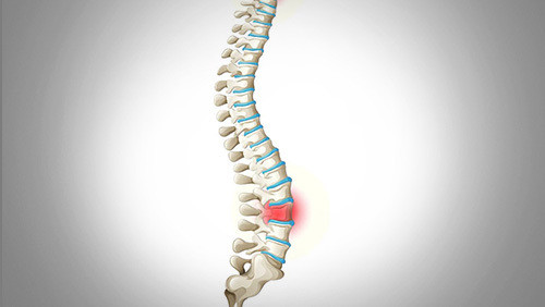 腰背痛不一定是腰椎间盘突出,也有强直性脊柱炎可能,强直,腰突怎么