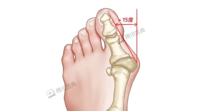 这种脚病俗称为大脚骨,医学上称为拇外翻.