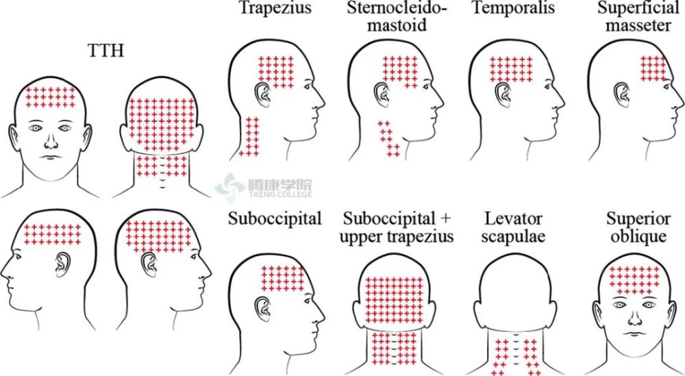 紧张性头痛的解析及诊疗