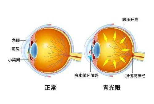 【医伴旅】治疗原发性青光眼高眼压症有了新突破