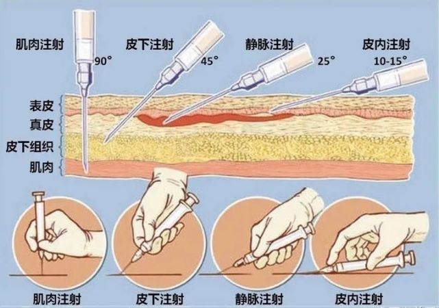 目前已获批的5个新冠病毒疫苗接种部位均为上臂三角肌,接种途径为