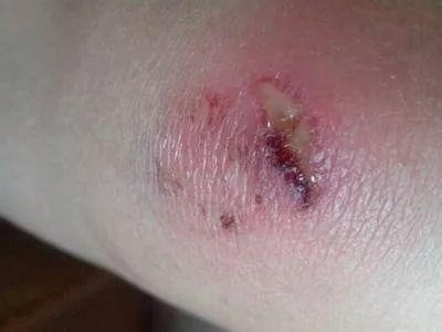 伤口红肿 腾讯网