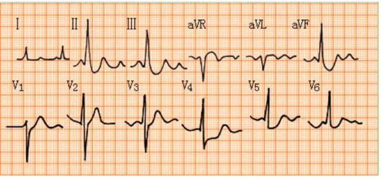 这6种常见心电图你一定要学会!