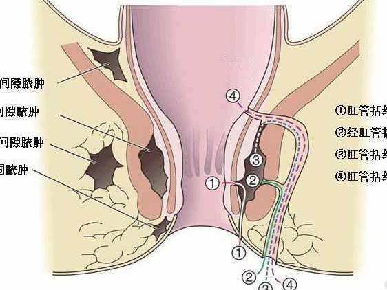 肛周疼痛,究竟是什么病?
