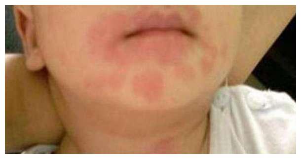 生殖疱疹医院排名(3)