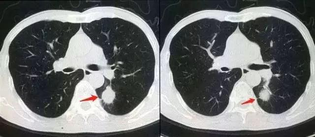 ct,胸片和磁共振,肺结节复查时哪个检查效果既好又