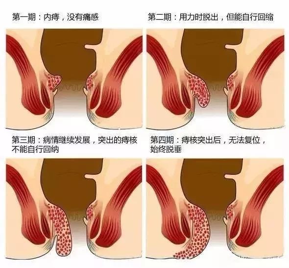 环状混合痔主要症状通常为 大便时出血,或伴痔核脱垂.