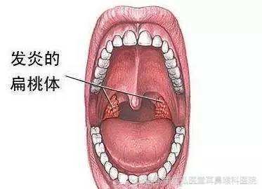 重庆弘医堂耳鼻喉医院讲解:儿童扁桃体炎有哪些症状