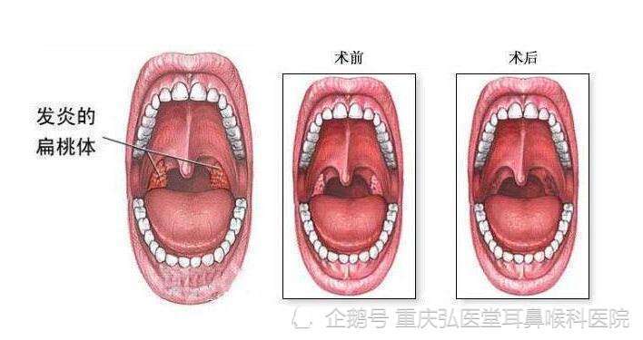 重庆弘医堂耳鼻喉医院讲解:儿童扁桃体炎有哪些症状表现