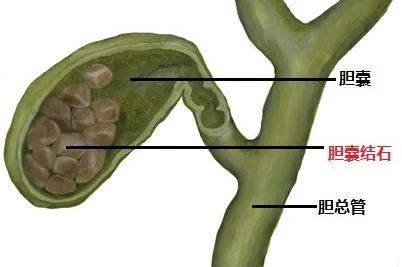 胆结石百科全书