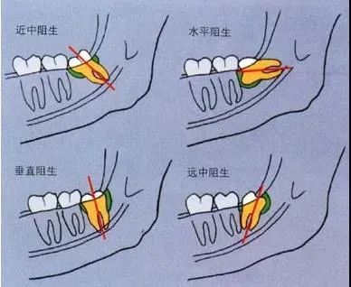 这几种智齿不疼也得拔,否则后果很严重!快看看你长了没