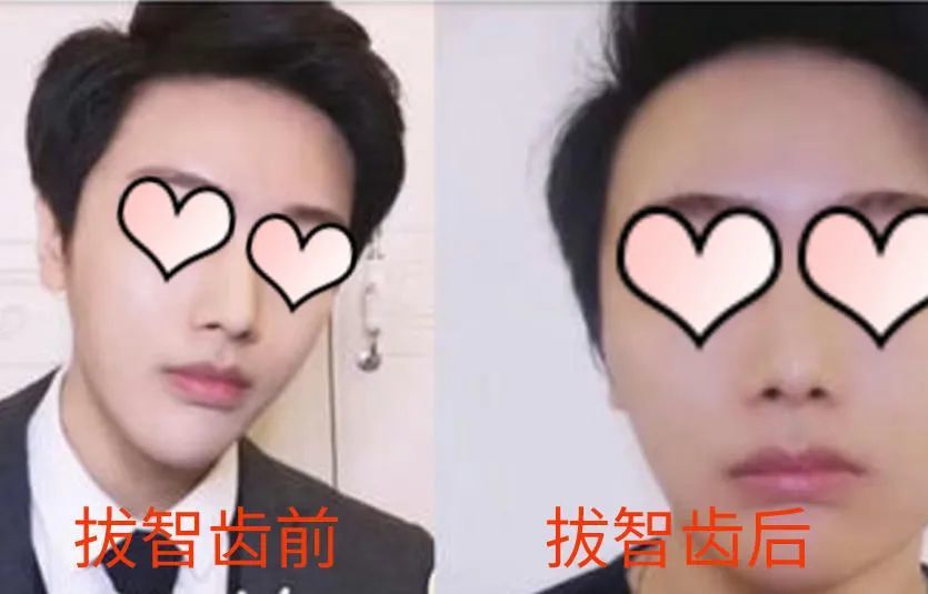 小兔良心建议,智齿不要一下拔两边.尖脸变大方脸不说,吃饭都成问题了.