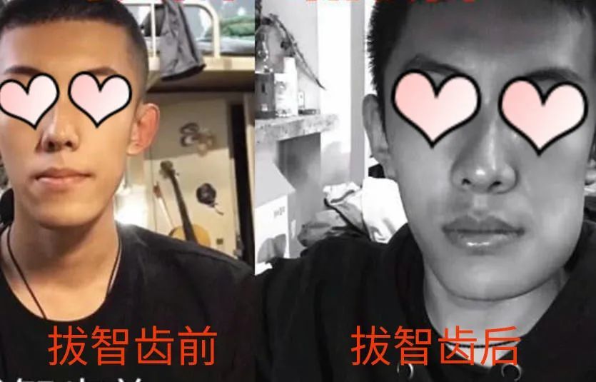 这几种智齿不疼也得拔,否则后果很严重!快看看你长了没