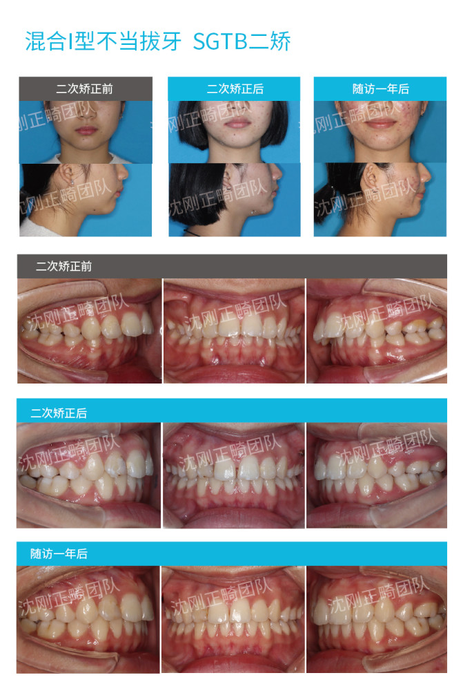 下图为沈刚正畸团队为某混i病例使用sgtb进行二矫时口内口外对比照