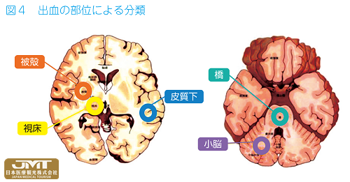 jmt日本干细胞中心-脑中风脑梗脑出血最大的原因及干细胞治疗