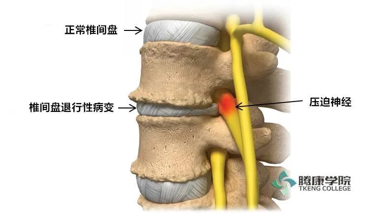 腰椎退变是与老化相关的过程,可能发生于脊柱的各个节段.