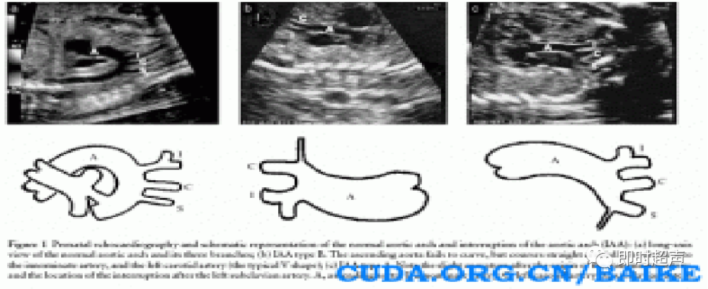 胎儿心脏三血管切面详解