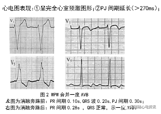 预激综合征心电图少见表现与诊断思路