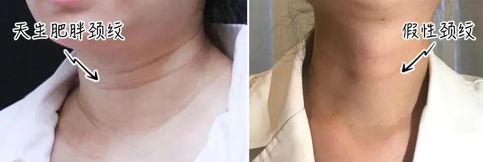 脖子有颈纹老10岁肌肤小熨斗一次滑到饱满嫩到想亲