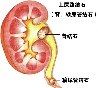 输尿管结石和肾结石的症状基本是一样的,输尿管中上段结石引起的输尿