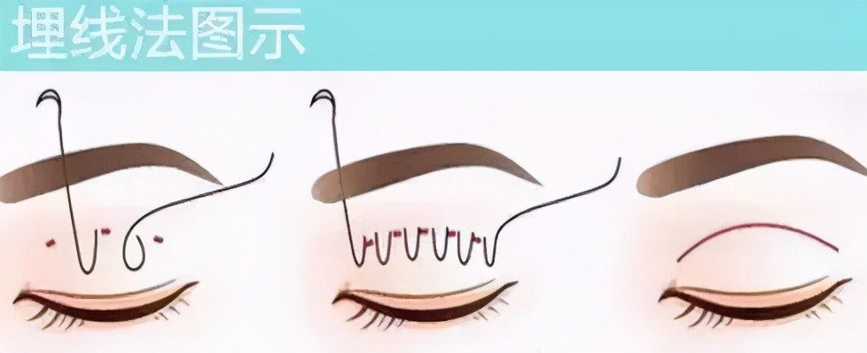 杭州双眼皮|明明可以做埋线,为什么非要做全切双眼皮?