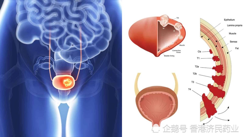 膀胱癌如何治疗?6种经fda批准的膀胱癌免疫治疗方案