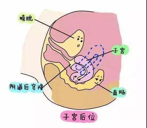 三种子宫类型你需要了解