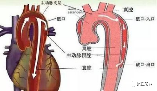 主动脉是人体最粗的血管,动脉壁分内膜,中膜及外膜三层.