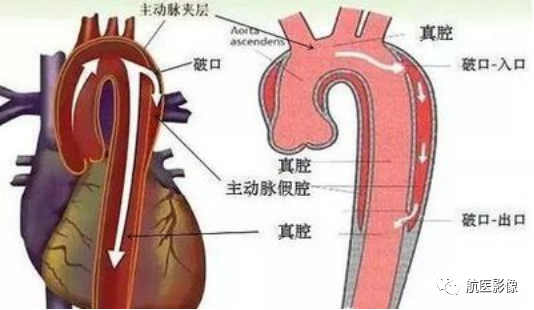 "不定时炸弹"-主动脉夹层|血管|cta|主动脉夹层|主动脉