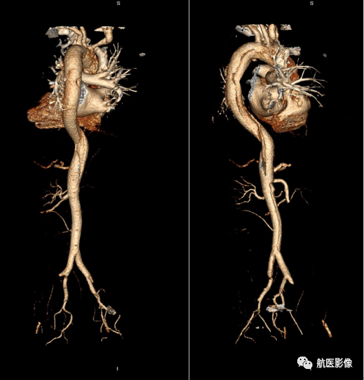 图为患者cta检查的vr图像图为主动脉夹层患者的曲线重建图像,可以清楚