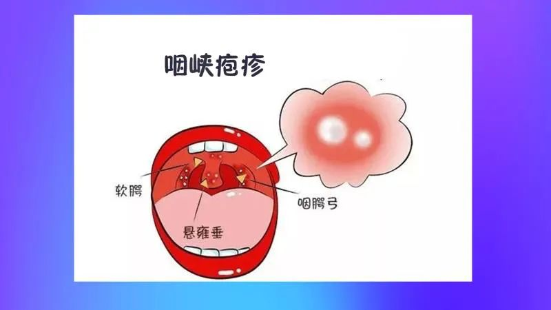 周围有红晕,1-2日后破溃形成小溃疡,表面附有浅黄色或白色假膜