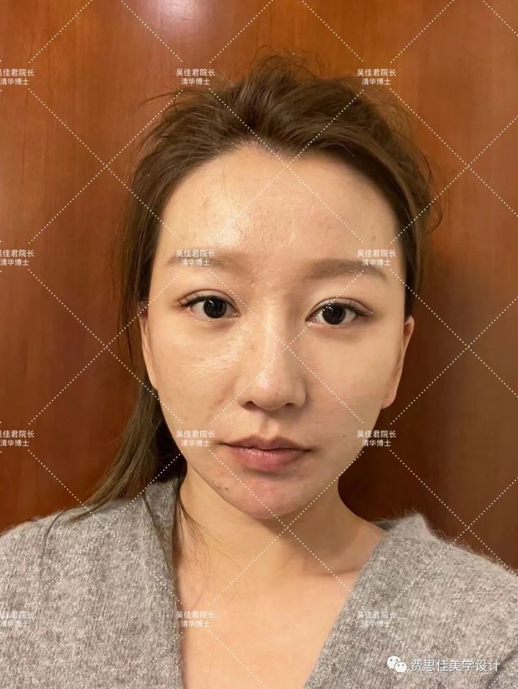 术后2个月侧面 做完小拉皮手术早期会有哪些感受?