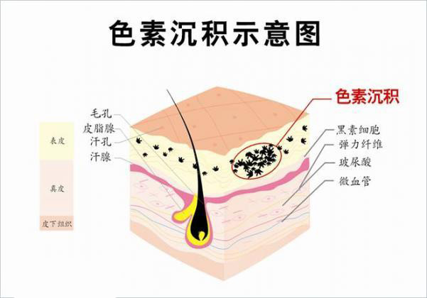 色素沉淀的原因是什么?成都疤研疤痕医院专业诊疗色素沉淀效果看得见