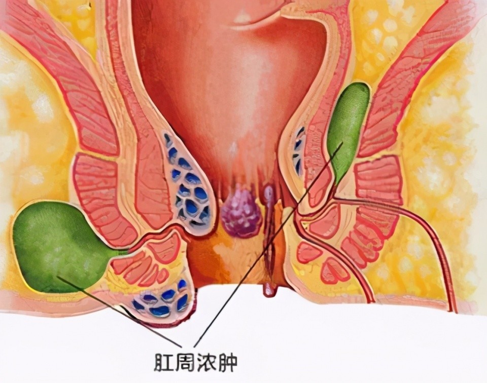 它,就是发生在肛门直肠周围的感染—肛周脓肿.感染,每个人都经历过.