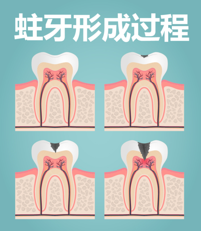 牙齿的损害不敏感,家长对孩子乳牙健康的保护意识缺乏,往往到了龋齿