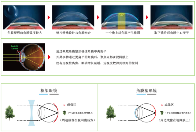 角膜塑形镜到底靠不靠谱?