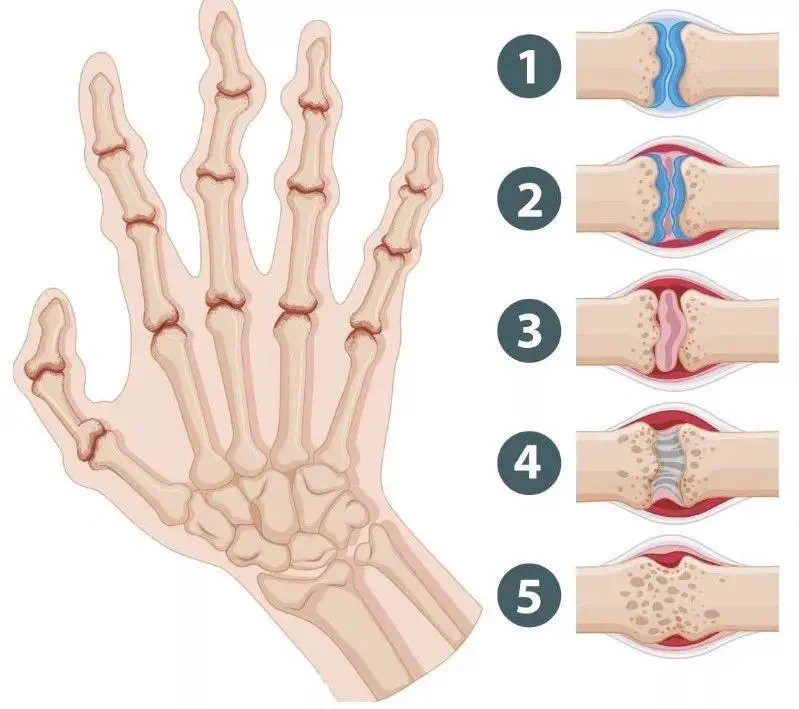 从手指可识别类风湿关节炎