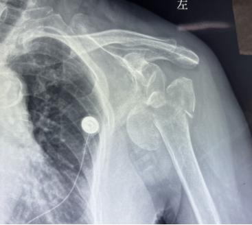 dr片提示:左肱骨近端粉碎性骨折并肩关节脱位