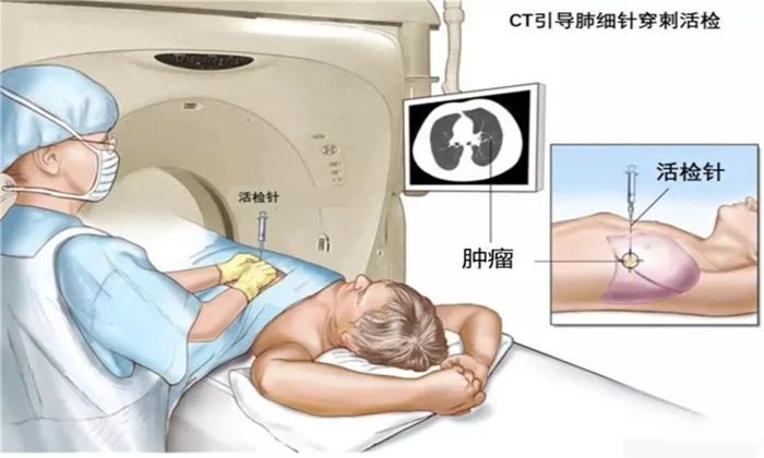 【谁与"针"锋】诊断肿瘤不开刀 穿刺活检术为肿瘤辩真凶