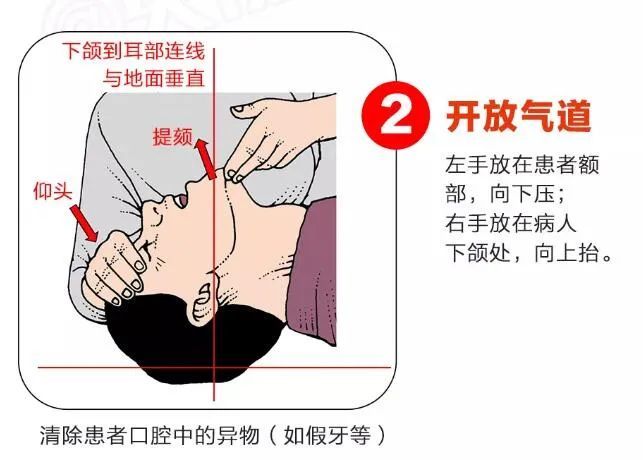 进行开放气道 将一只手放在患者额头,用另一只手的食指和中指提起