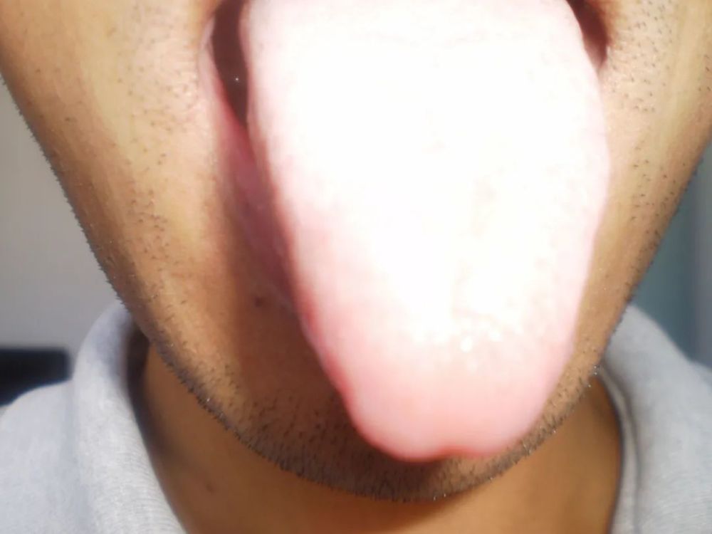 舌苔发白主要的一种就是舌头会比一般人的要大很多,并且会很明显地
