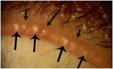 睑板腺消失,爱玩手机者更高发!这种病不是靠滴眼药水