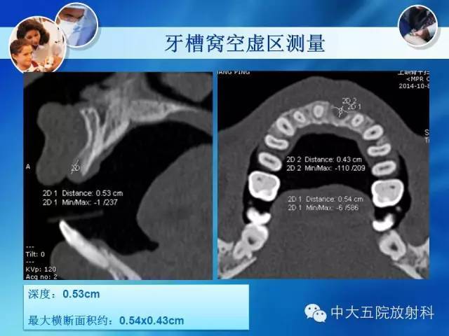 种植牙-ct照相与报告书写