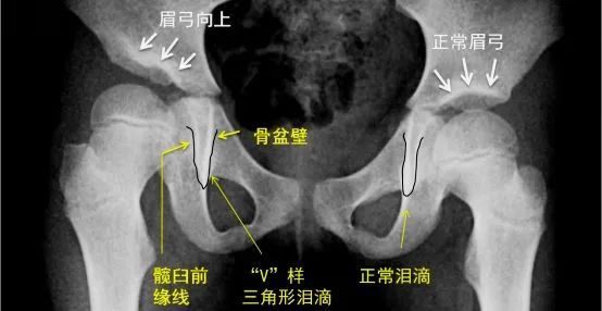 眉弓陡斜以及泪滴不连续或三角形,均提示髋关节应力异常,这些征象会