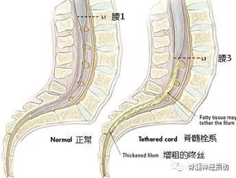 脊髓栓系综合征跟马尾神经什么关系?