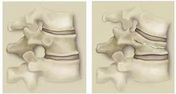 初步判断 李阿姨得的是 胸腰椎骨质疏松性 压缩性骨折 骨密度结果显示